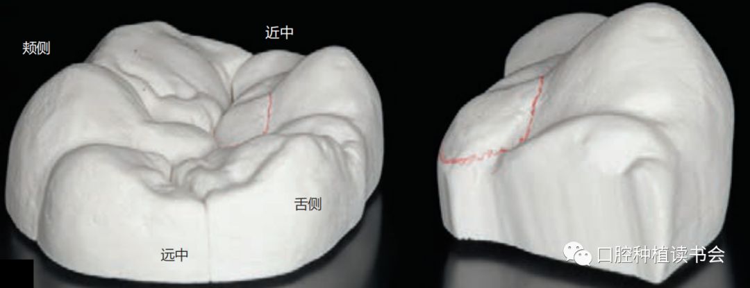 图6 在近中舌尖(36牙齿)上的"背包"(红色轮廓线)被塑型成近似平顶