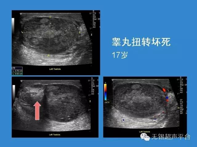 睾丸恶性肿瘤的超声诊断