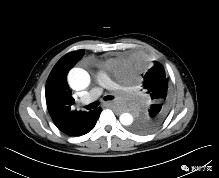 ct示 纵隔窗:左侧纵隔见巨大不规则软组织团块影,与周围大血管分界不
