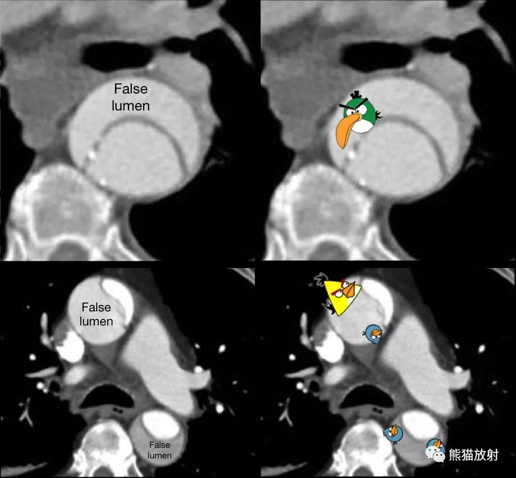 征象丨多脏器之"鸟嘴征"_乙状结肠