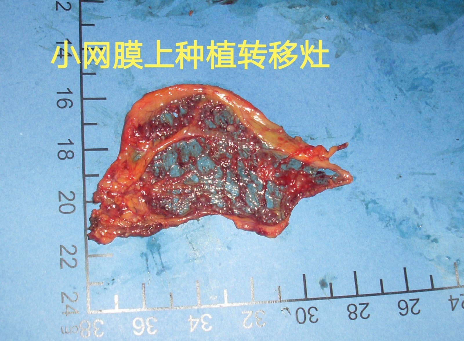 病例(21)--卵巢巨大囊肿实为阑尾来源pmp (原创)