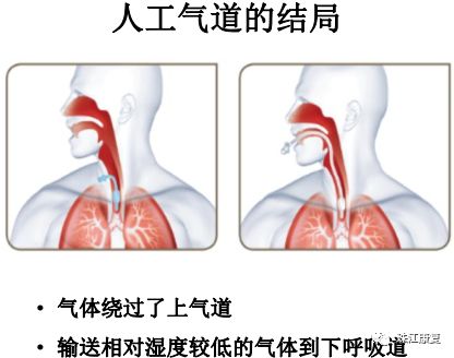 慢性危重症人工气道管理 - 中篇