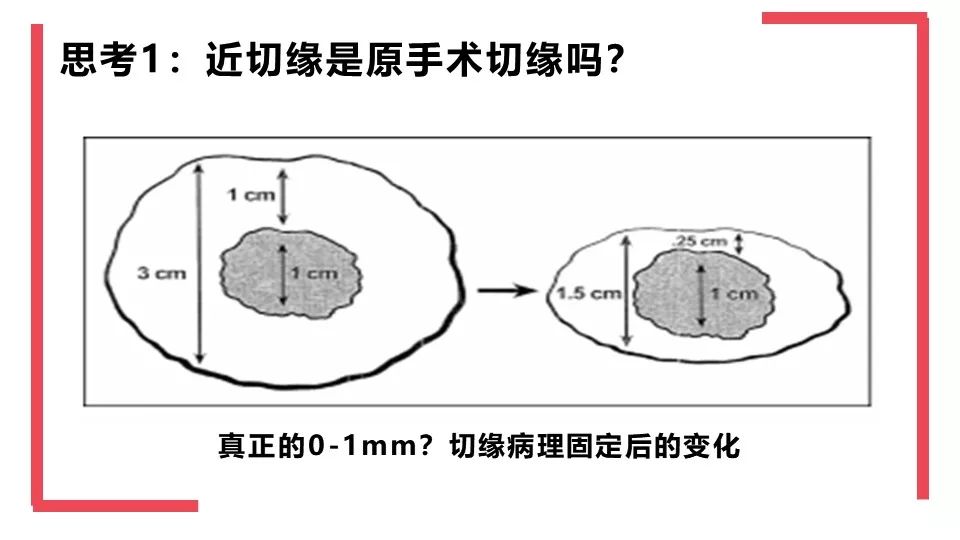 保乳近切缘(如0-1mm)到底安全不安全?