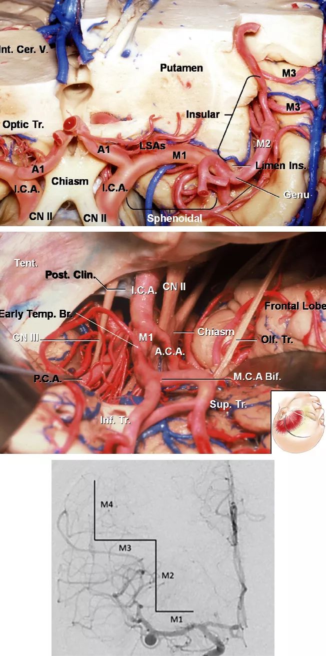 大脑中动脉动脉瘤手术策略与技巧 | the neurosurgical atlas全文翻译