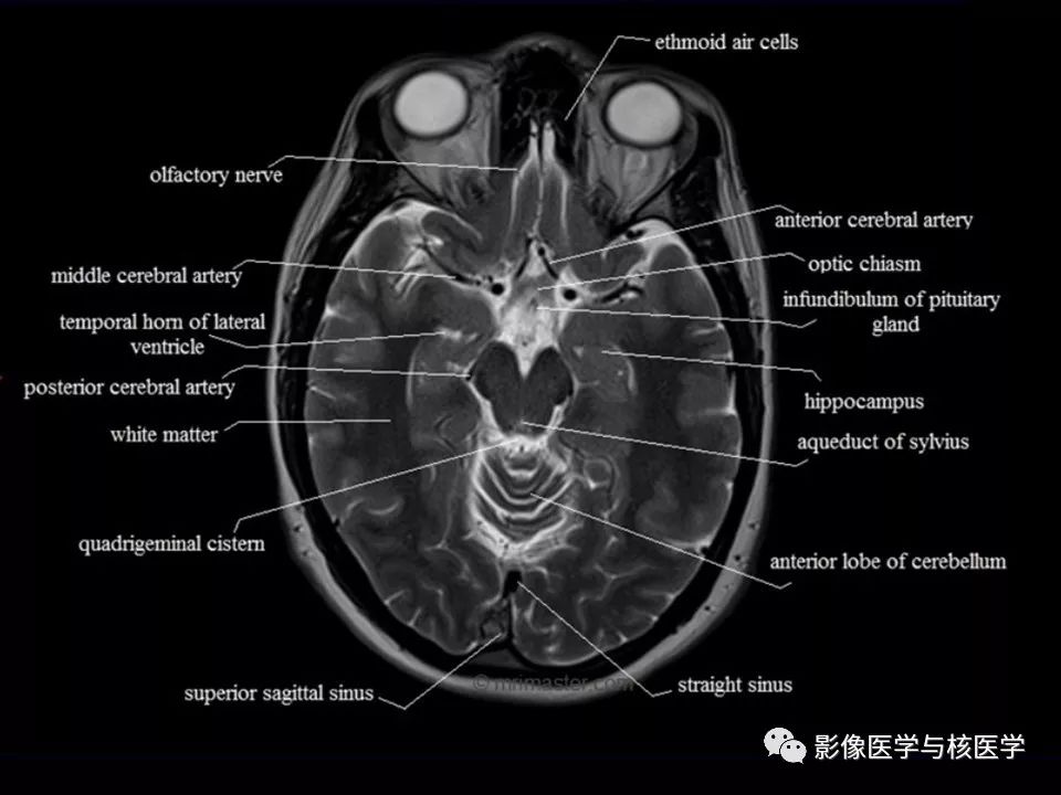 【影像解剖】头颅mr横断面解剖中英文对照