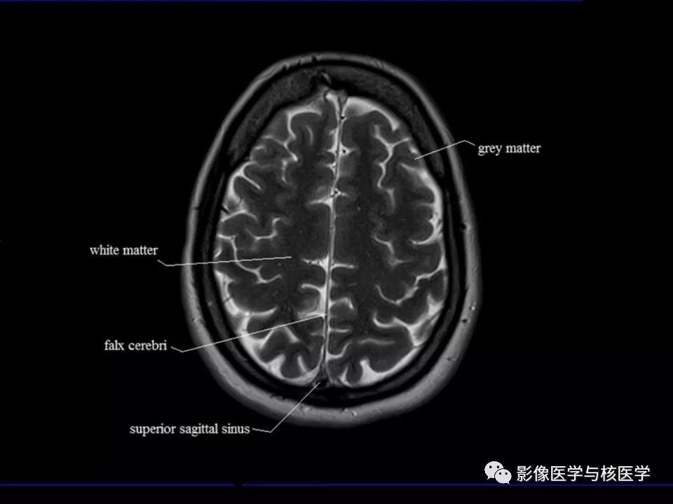 影像解剖头颅mr横断面解剖中英文对照