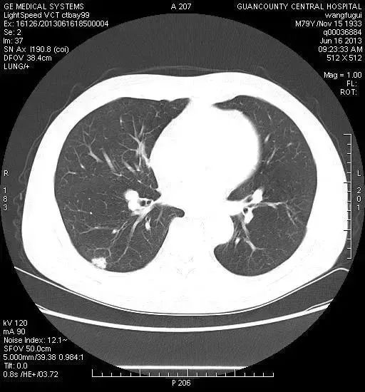 胸部低剂量CT--早期肺癌筛查的第一选择!