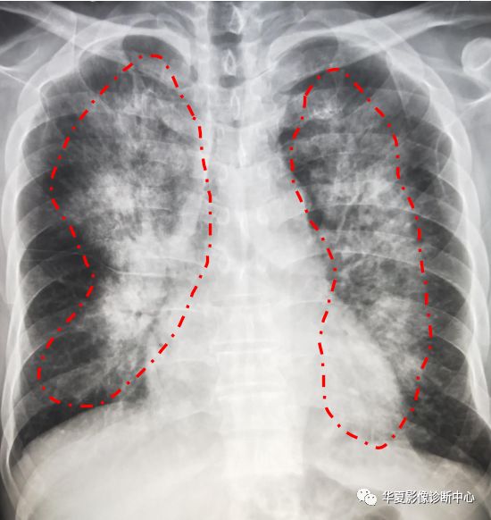 常见"肺门周围蝙蝠翼征"天使翼征"蝴蝶征.