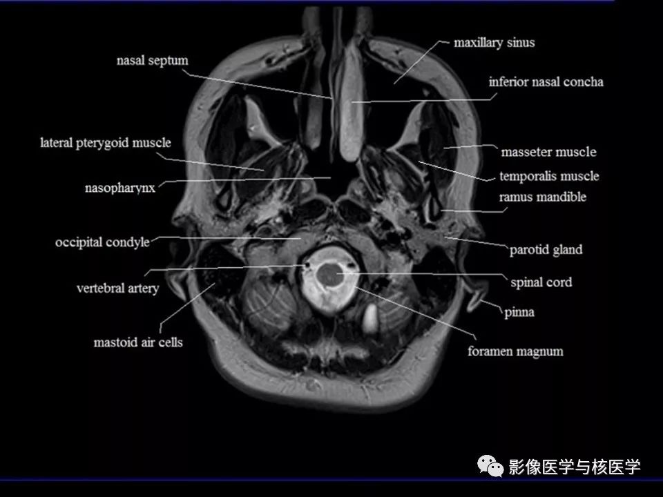 【影像解剖】头颅mr横断面解剖中英文对照