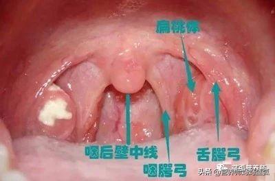                     扁桃体炎需三分治七分养，标本兼治才不容易反复！