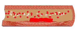 使管腔狭窄,血栓形成持续不断地形成增生7堆积在粗糙的受损组织表面