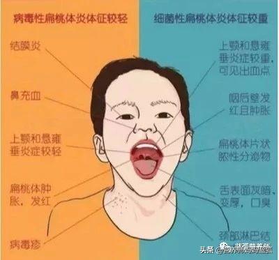                     扁桃体炎需三分治七分养，标本兼治才不容易反复！