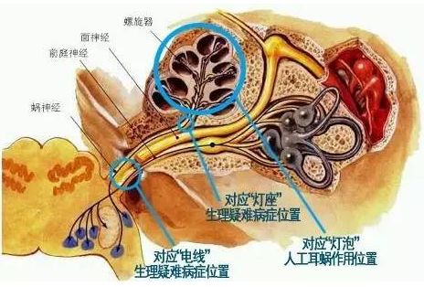 影响人工耳蜗术后效果的病症都有哪些?