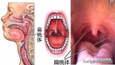                     扁桃体炎需三分治七分养，标本兼治才不容易反复！