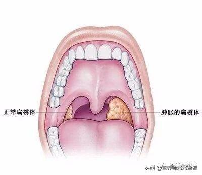                     扁桃体炎需三分治七分养，标本兼治才不容易反复！