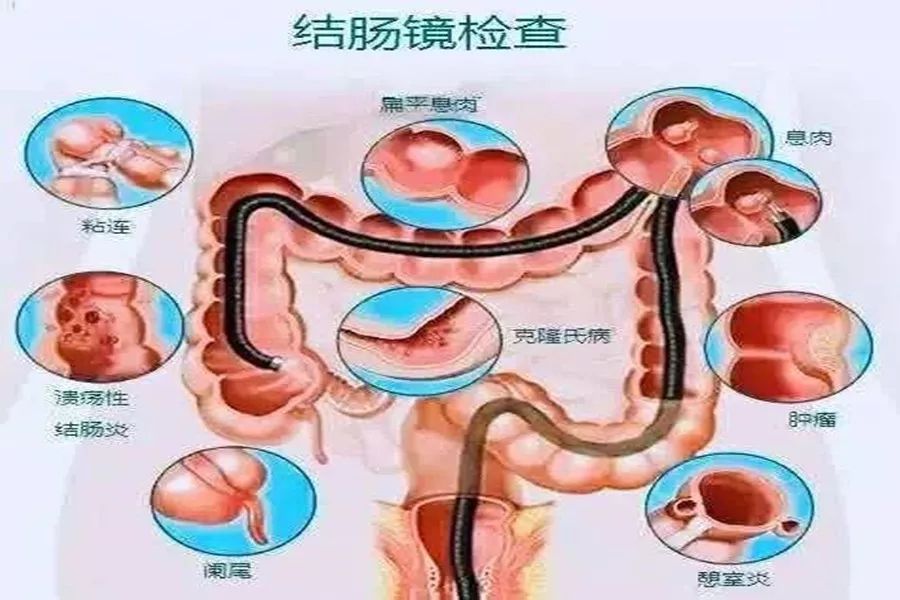 【无痛肠镜】给你的肠子做个体检吧!