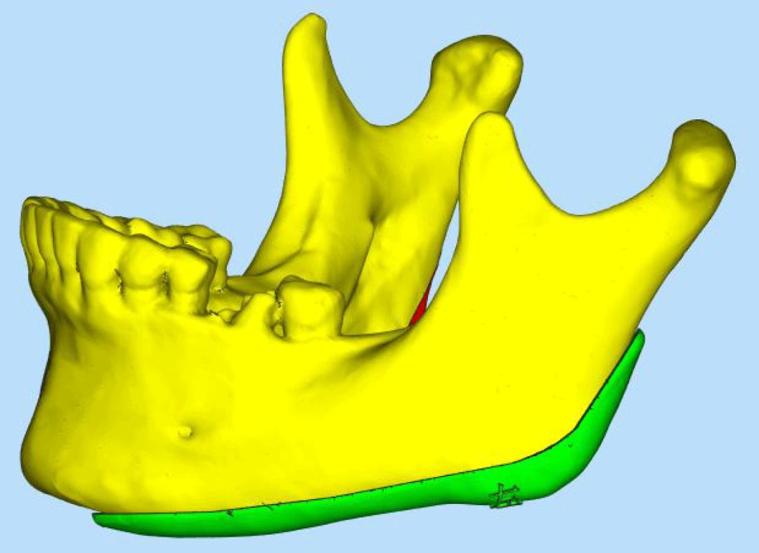 第二节 上颌前部骨切开术-口腔科学-医学