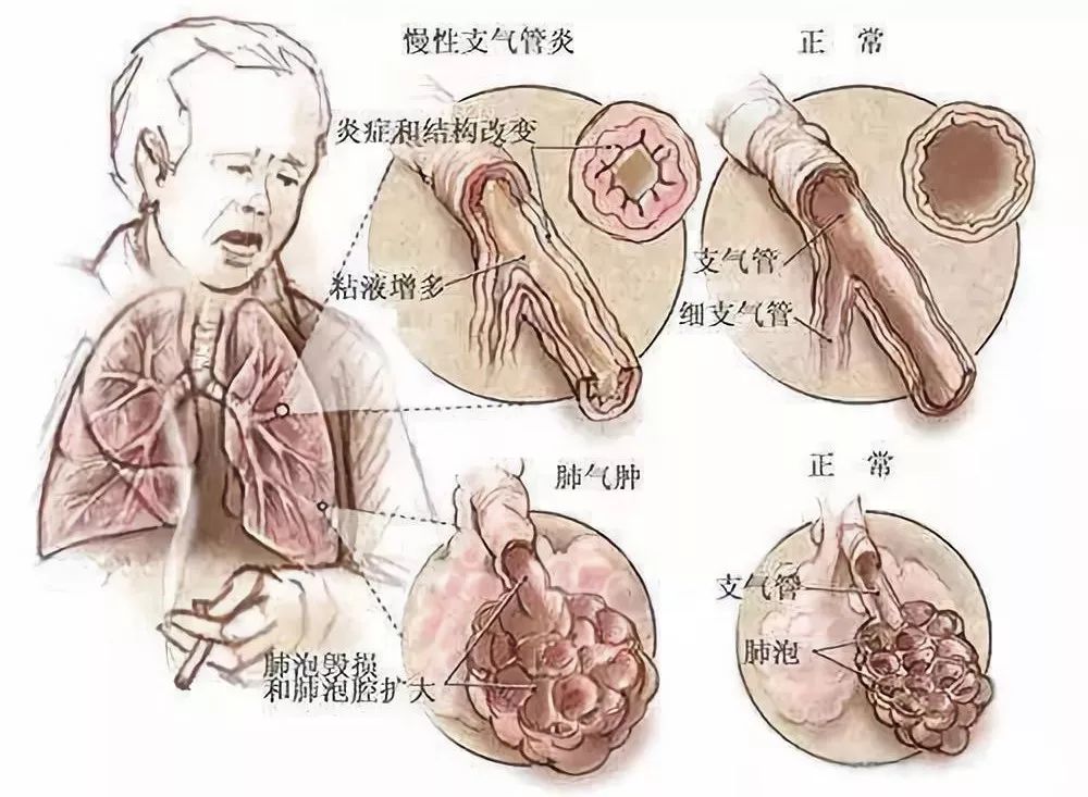 【健康生活】隐形杀手,慢性阻塞性肺疾病