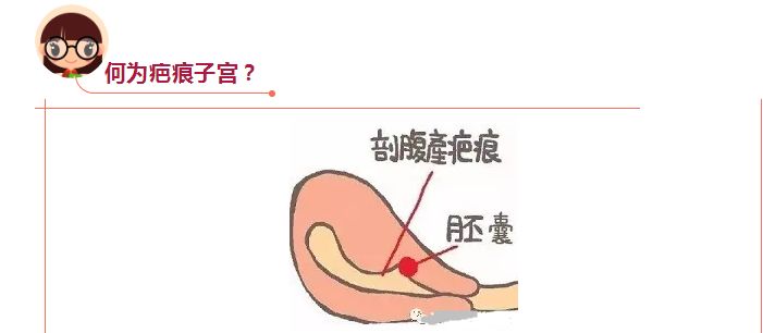 瘢痕子宫阴道再分娩,看看端州妇幼是怎么做的?