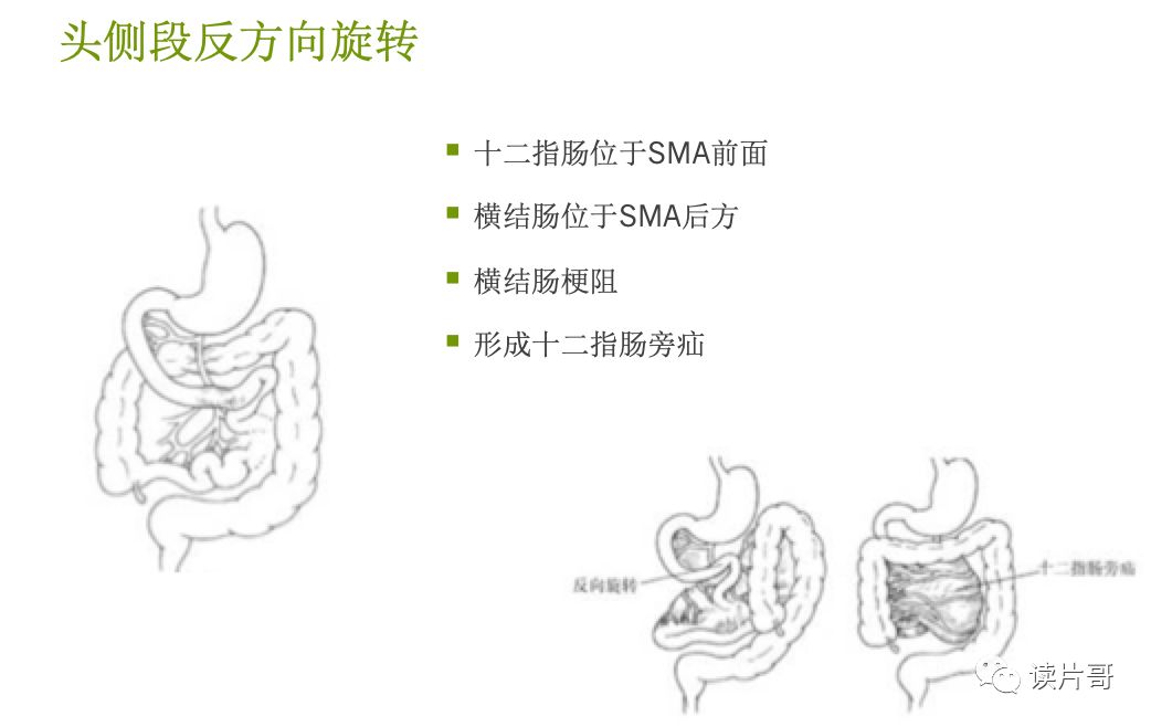 小肠先天性疾病