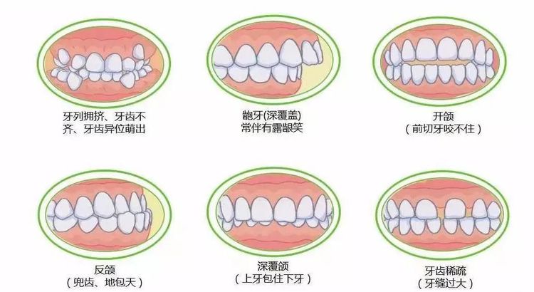 如何预防错颌畸形,牙齿不齐会影响你一生的颜值