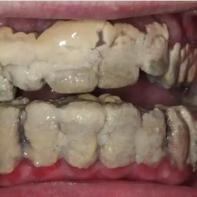 世界上最烂的牙齿能烂到什么程度?