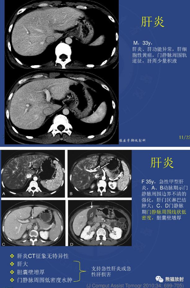 鉴别诊断丨肝门静脉周透亮或水肿(门静脉周围间隙增宽