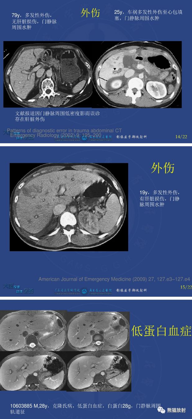 鉴别诊断丨肝门静脉周透亮或水肿(门静脉周围间隙增宽)