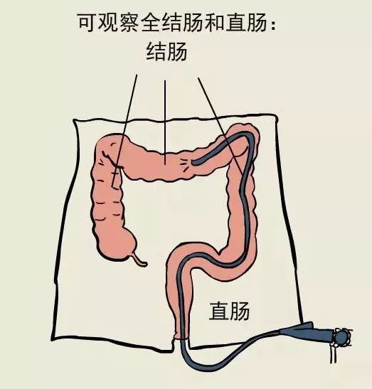 电子肠镜检查是经肛门将电子肠镜插入,进入肠内,观察到大肠粘膜的