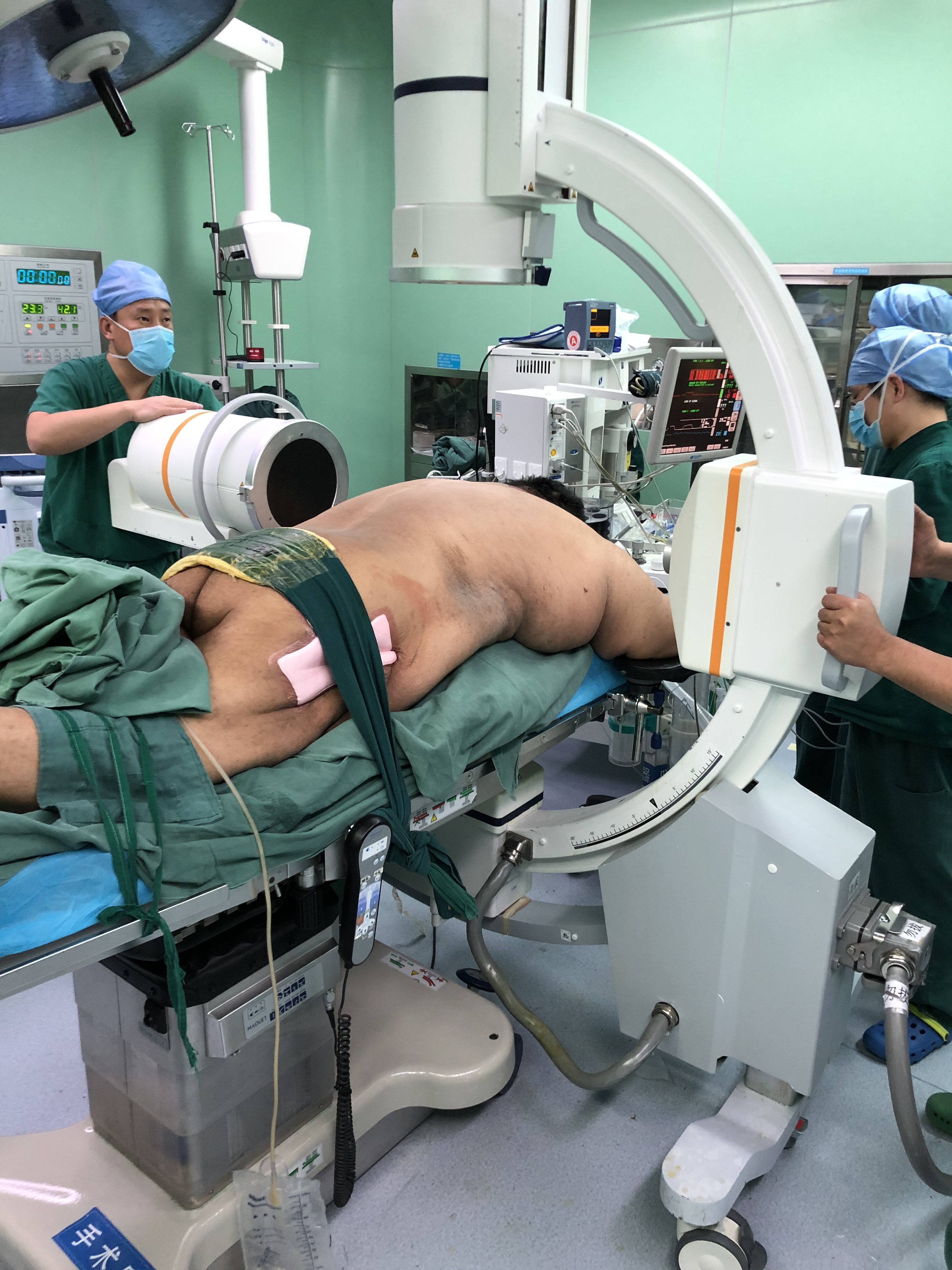 340多斤的胖子胸椎管狭窄手术如何做? (原创)