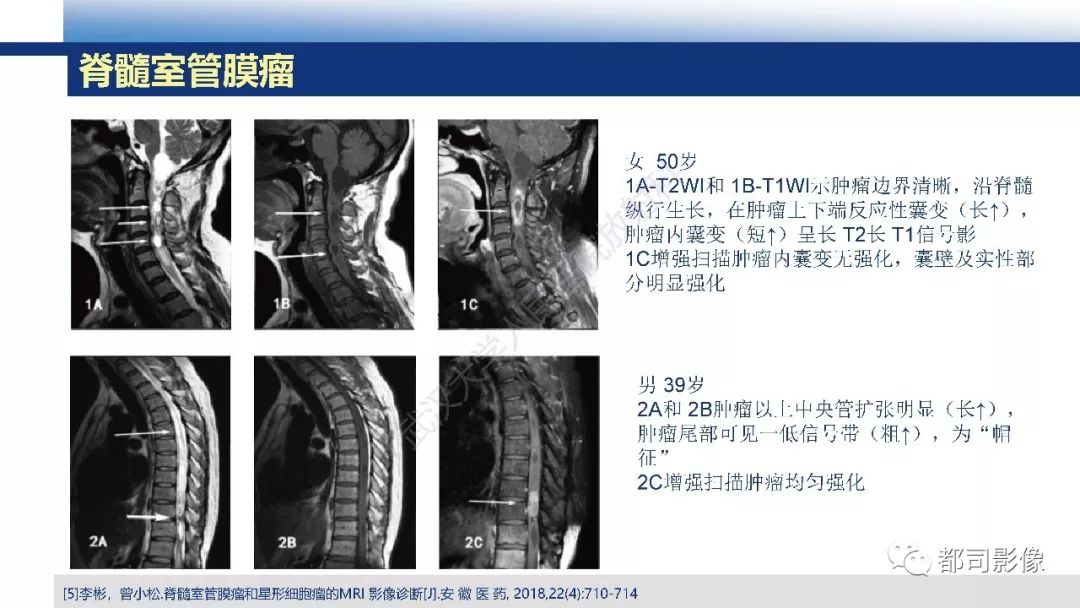 脊髓髓内神经鞘瘤影像诊断