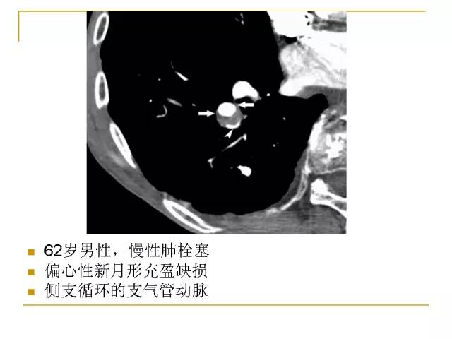 【经典讲座】肺动脉栓塞cta