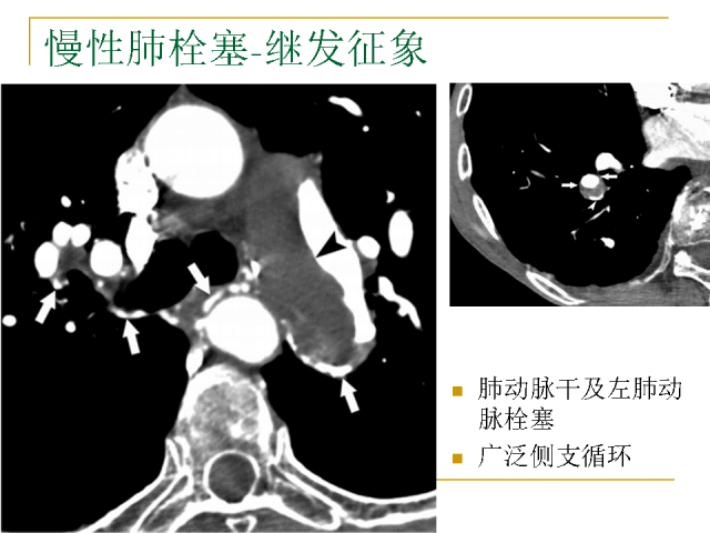 【经典讲座】肺动脉栓塞cta