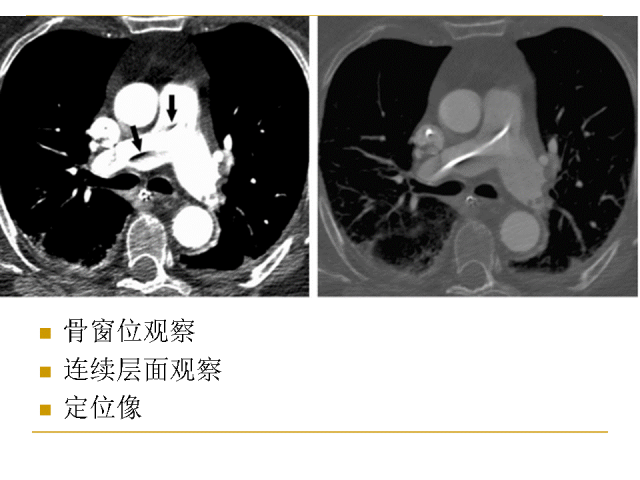 【经典讲座】肺动脉栓塞cta