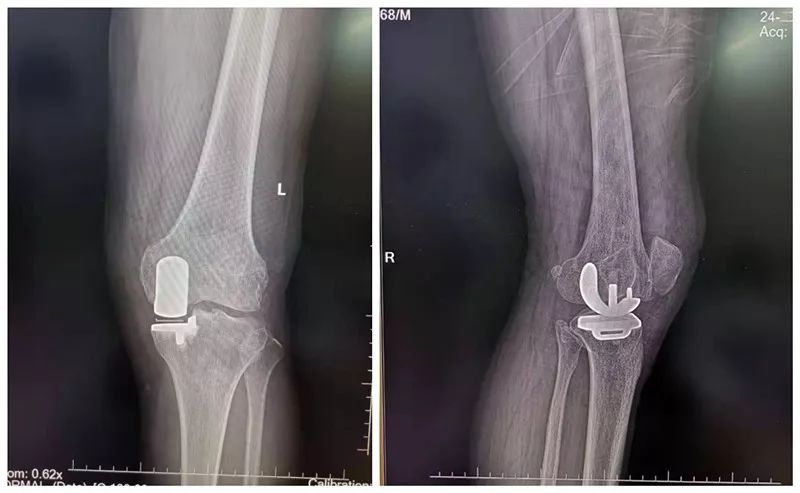 【新技术】骨三科成功开展我院首例微创膝关节单髁置换手术