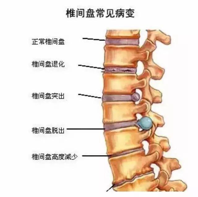 长圆针治疗腰椎间盘突出是什么原理