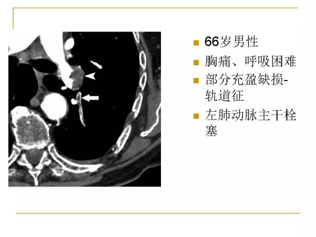 【经典讲座】肺动脉栓塞cta