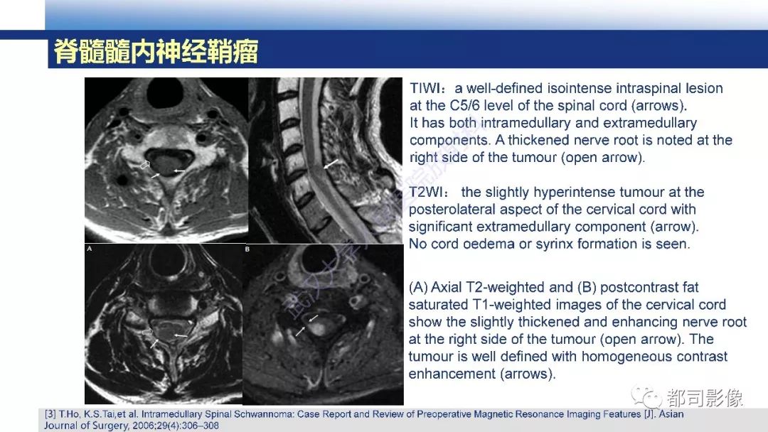 脊髓髓内神经鞘瘤影像诊断