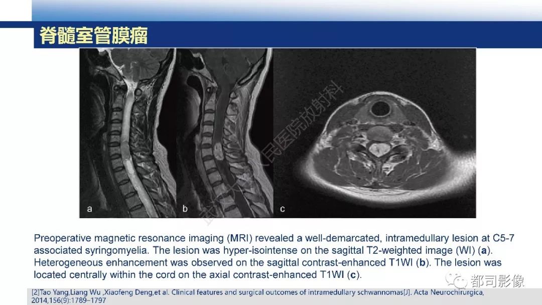脊髓髓内神经鞘瘤影像诊断