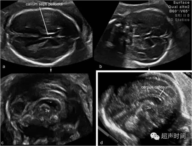 超声如何完美显示胎儿胼胝体