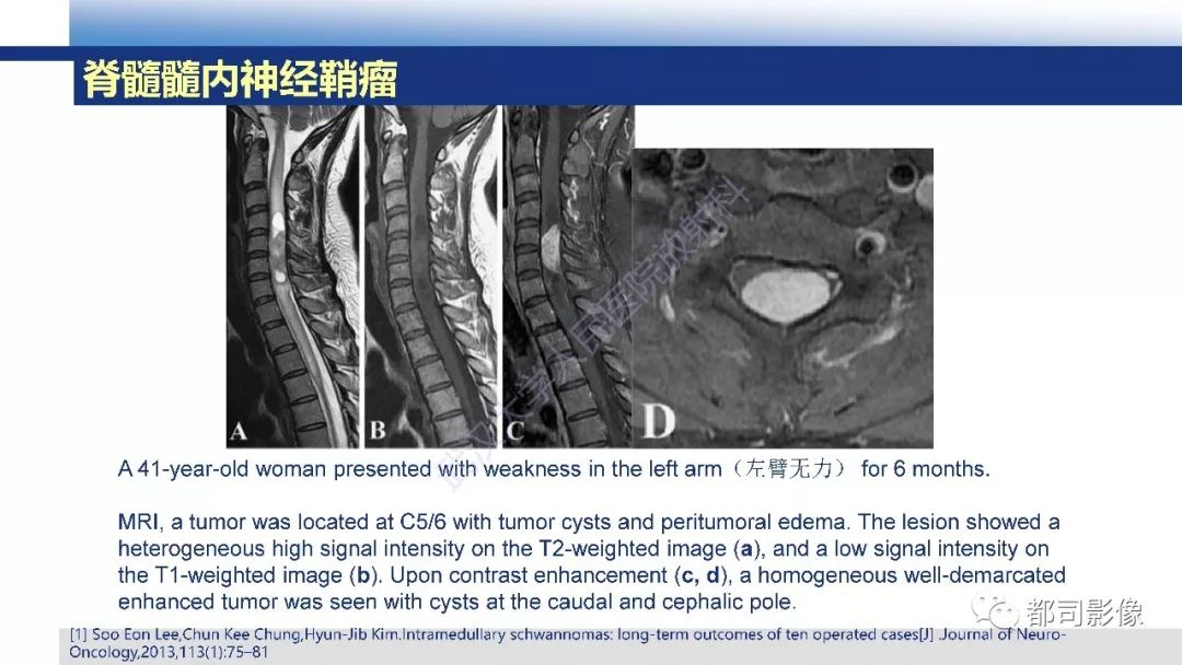 脊髓髓内神经鞘瘤影像诊断