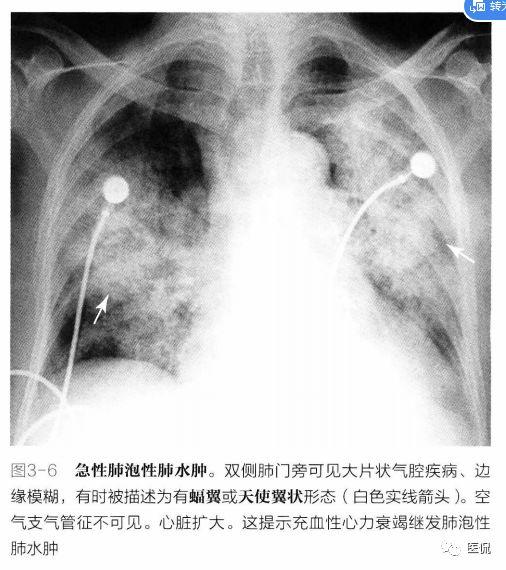 心源性肺水肿,常伴随有胸腔积液且液体使斜裂和水平裂增厚.