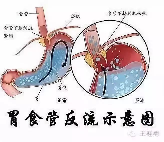 咽酸怎么办