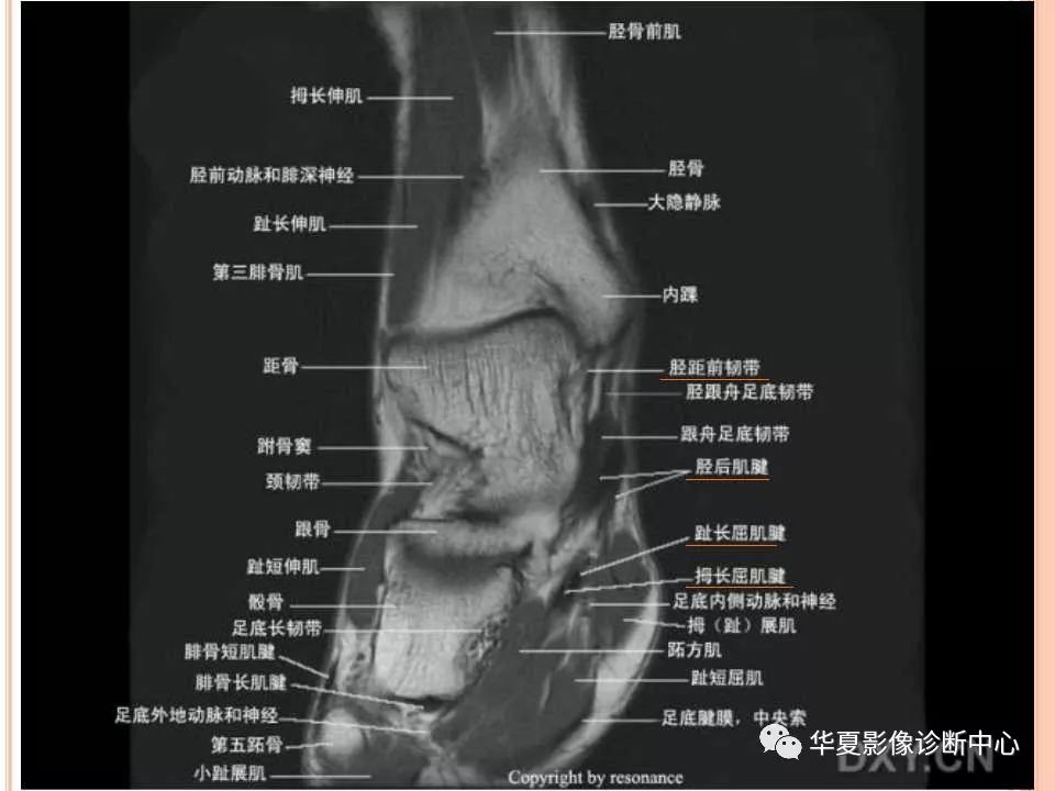 踝关节mri解剖及常见损伤类型