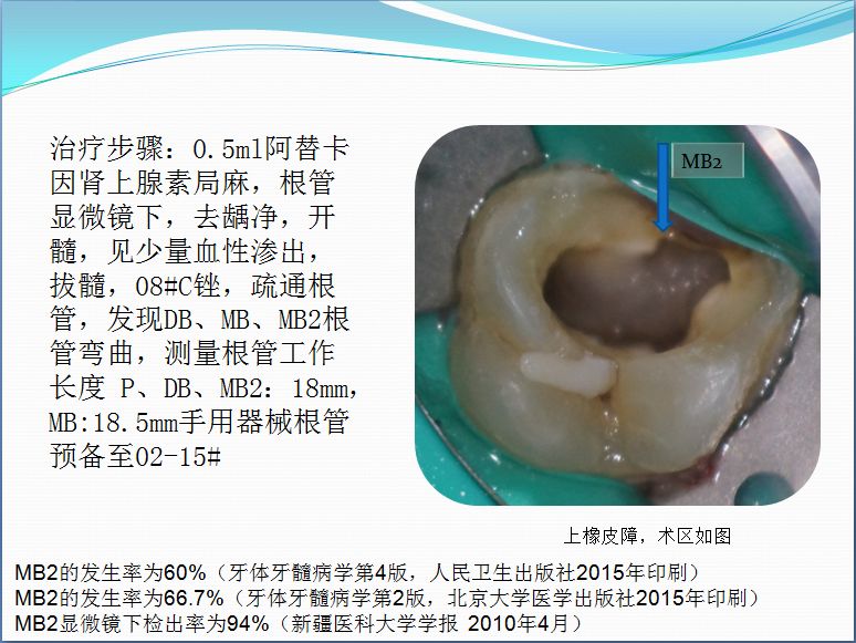 上颌第一恒磨牙dbmbmb2弯曲根管一次性根管治疗及数字化冠修复第三届