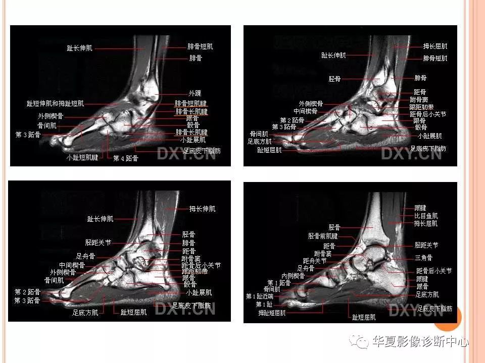 踝关节mri解剖及常见损伤类型