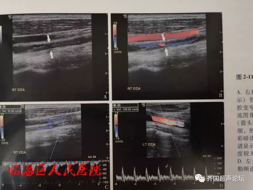 基础大动脉炎的超声诊断
