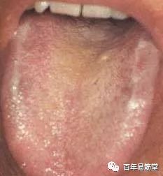 5,白粘腻苔本图患者为慢性支气管炎,舌苔白腻,舌上水湿过多,舌色淡紫