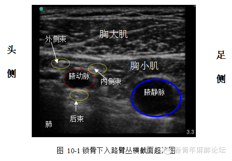 超声引导下臂丛神经阻滞