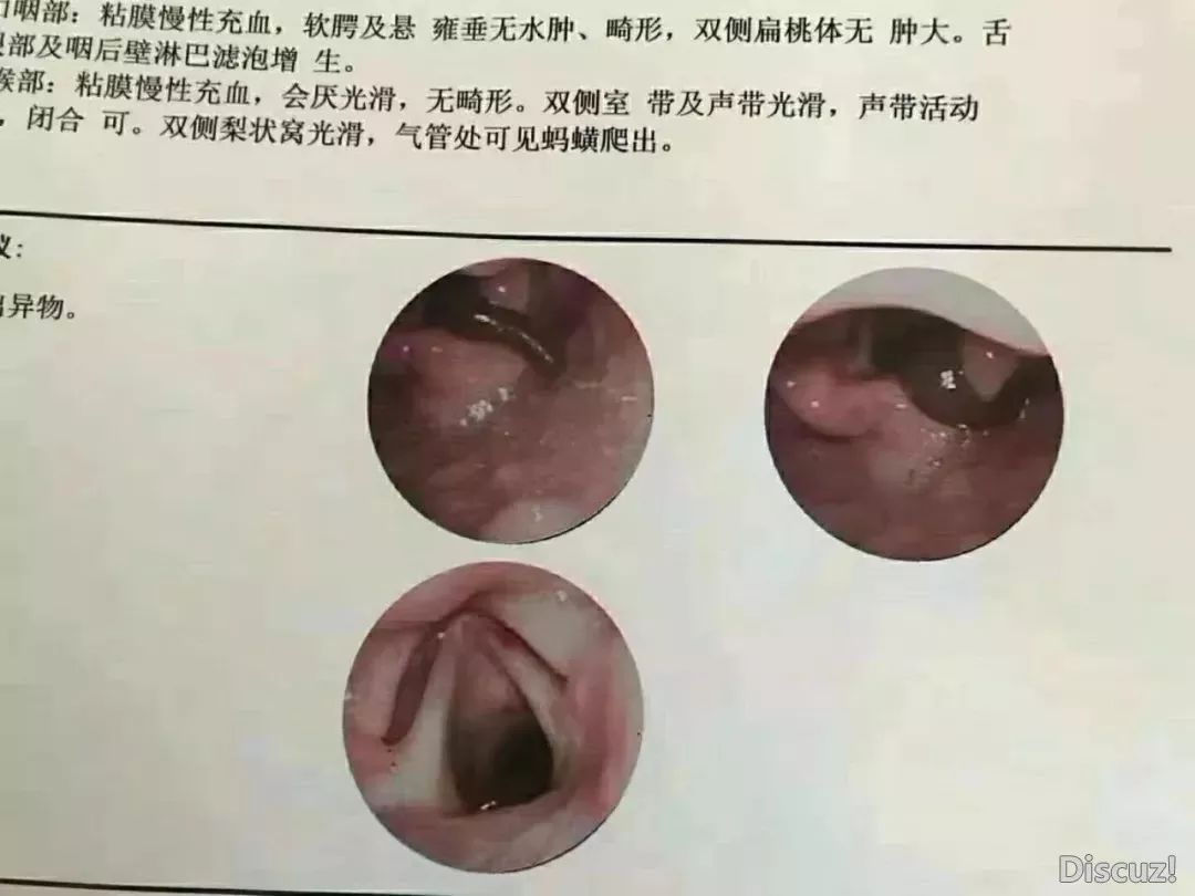 太恐怖!云南一男孩咽喉部取出一条8公分活蚂蝗_蚂蟥